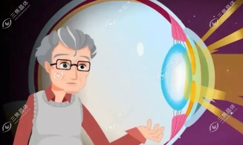 双眼白内障做一只眼行吗?不行/千万别自作聪明做单眼白内障