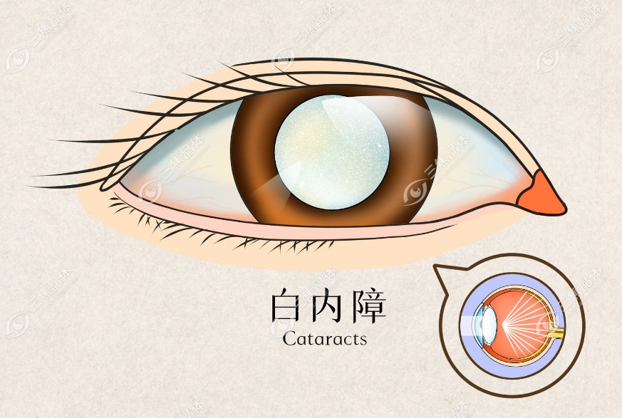 角膜内皮细胞形态异常可以做白内障手术吗