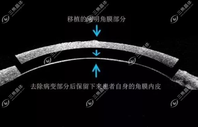 角膜斑翳消除办法2：板层角膜移植术
