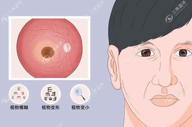 中心性浆液性视网膜脉络膜病变症状