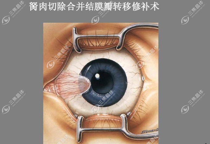 翼状胬肉切除术+自体结膜移植术是几级手术?一级手术