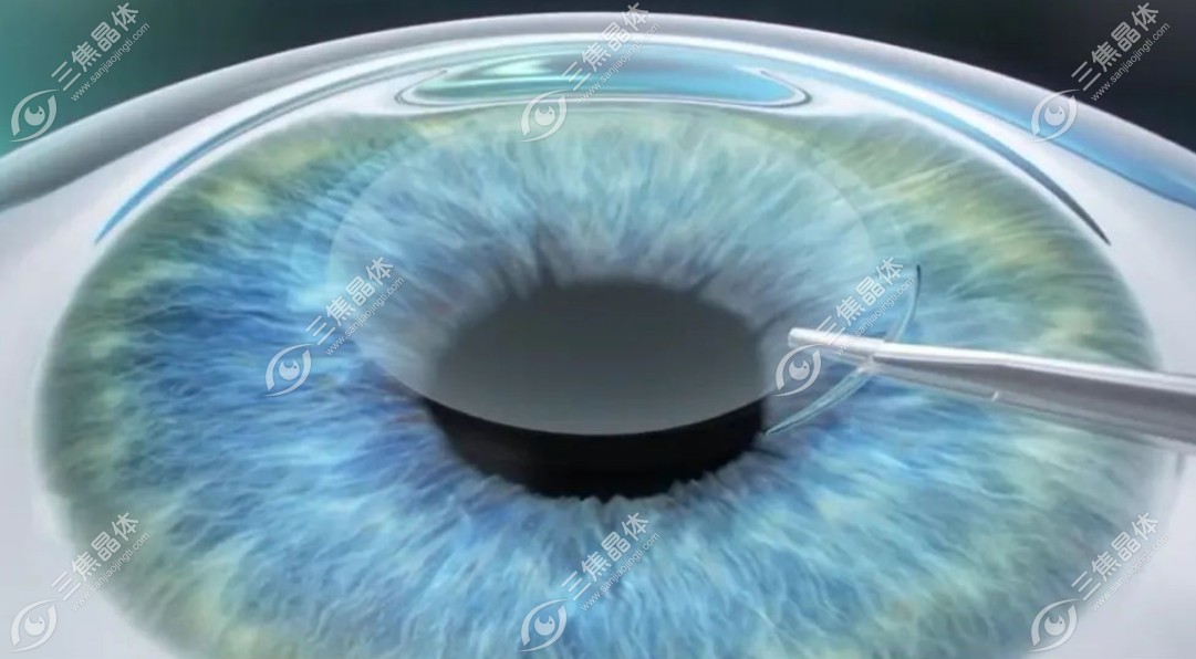 半飞秒选择蔡司visumaxs还是鹰视FS200因人而异