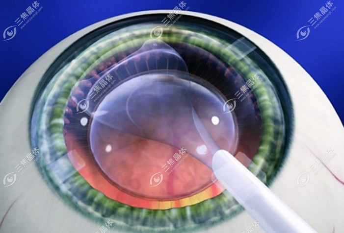 千万别做晶体植入手术,做了晶体植入手术好后悔,想把icl取出