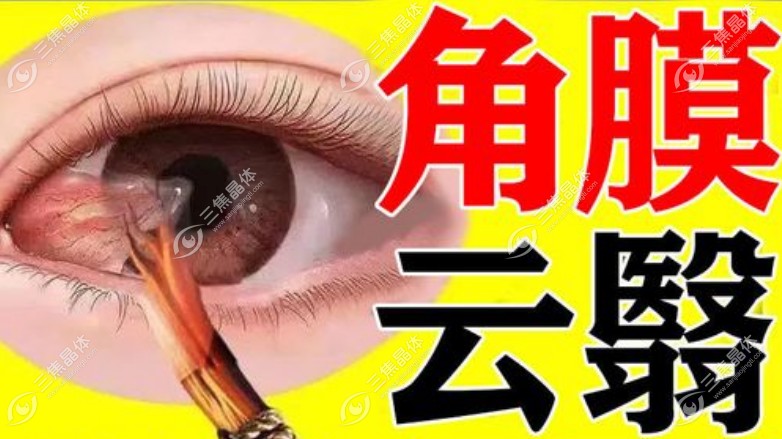 角膜云翳新治疗方法:板层角膜移植术治好了我的角膜云翳