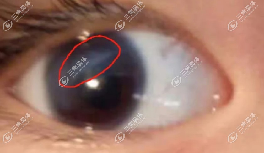 角膜云翳新治疗方法:板层角膜移植术治好了我的角膜云翳
