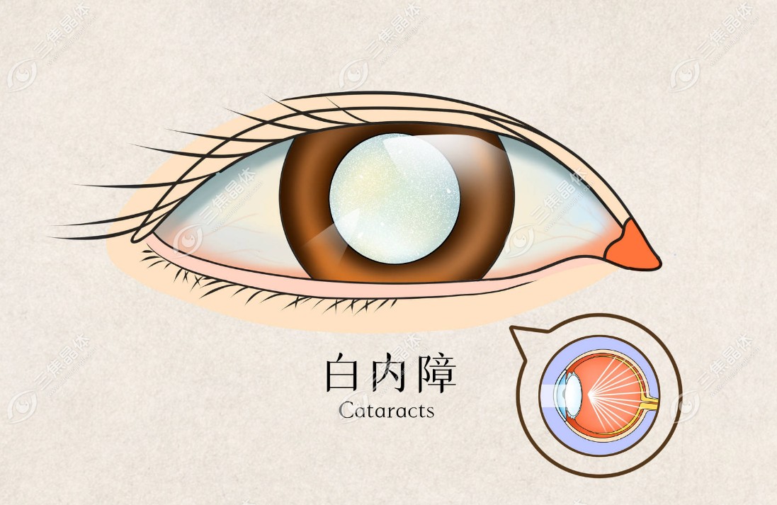 北京爱尔英智眼科医院www.sanjiaojingti.com