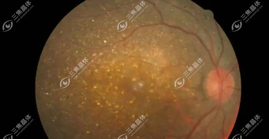 眼睛coats病是一种比较罕见的眼底疾病www.sanjiaojingti.com