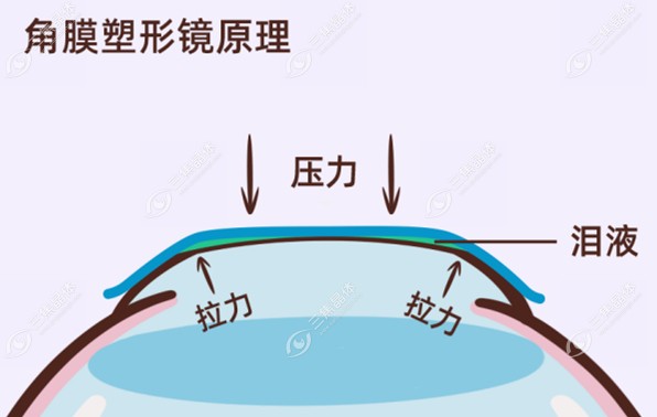 角膜塑形镜的近视防控原理