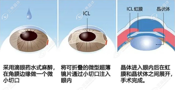 前房深度2.7或2.76可以做ICL吗？  不推荐