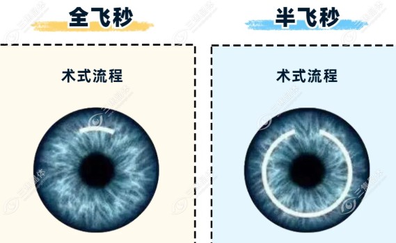 近视50-1800度都适合做近视眼手术