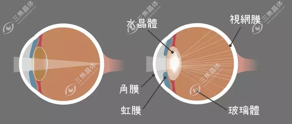怎样判断是不是晶状体移位了www.sanjiaojingti.com
