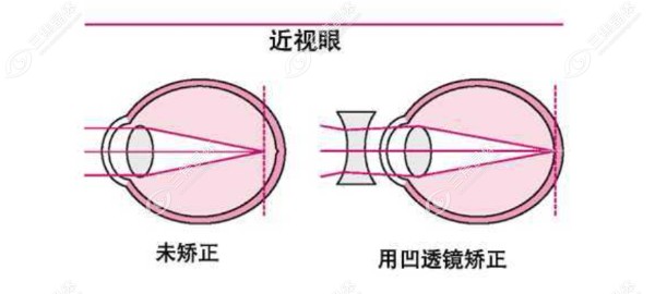 浙江温岭近视矫正手术