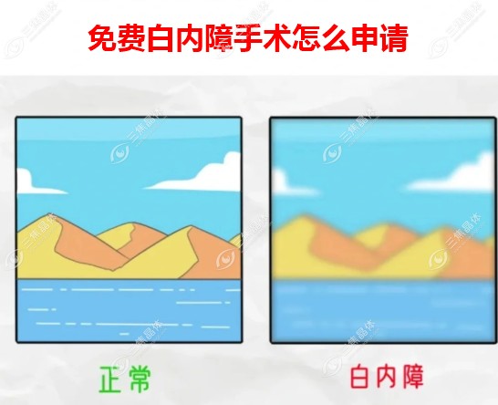老年人免费白内障手术怎么申请