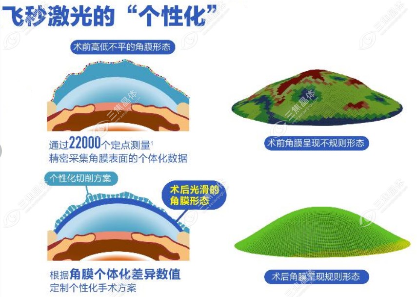 普通半飞秒和个性化半飞秒选哪个? 优先选个性化半飞秒。