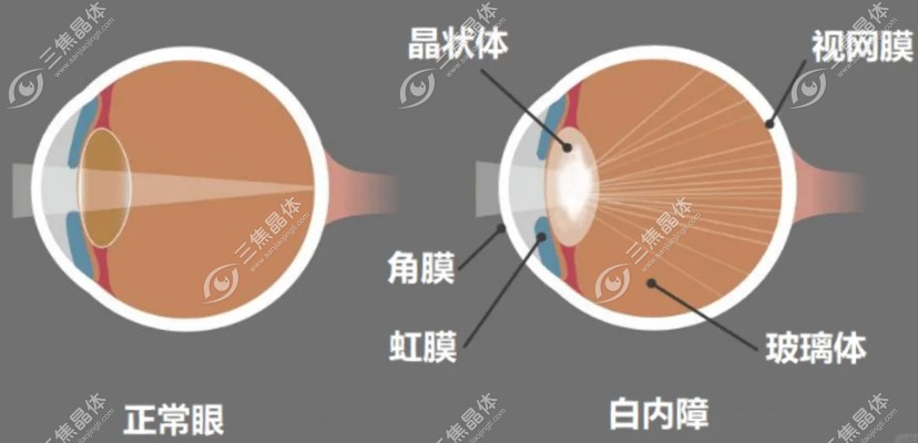 免费白内障手术条件