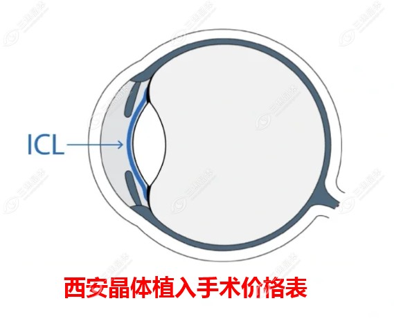 西安晶体植入手术价格表