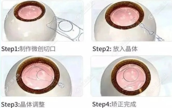 国内高度近视晶体植入手术好的医院排名