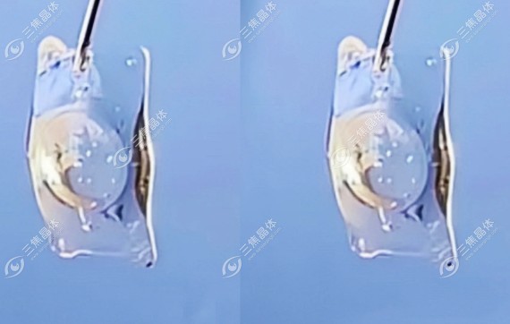 icl晶体植入术后视力清晰