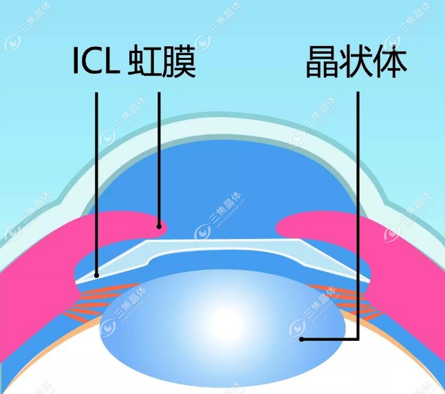 icl拱高多久能稳定