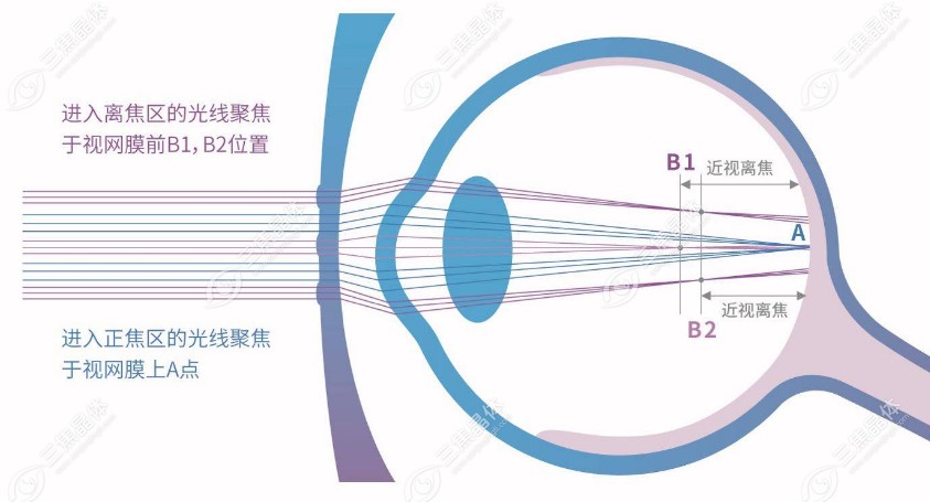 有散光的孩子戴离焦镜片好吗?好!戴离焦镜可避免散光加重