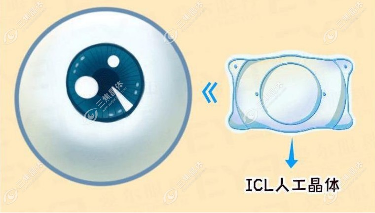 icl拱高是什么意思