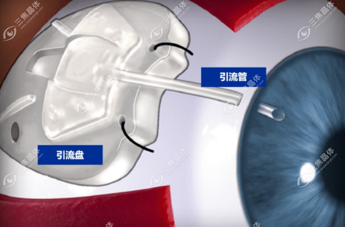 青光眼装阀可管一生吗？不能