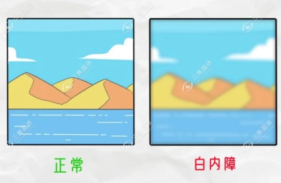 白内障手术报销比例是70%左右