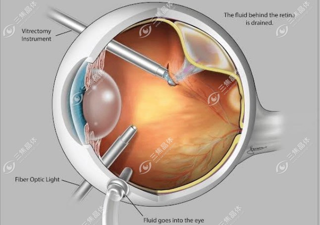 西安做视网膜脱落手术费用:5k-3w左右,可用医疗保险报销50%-70%