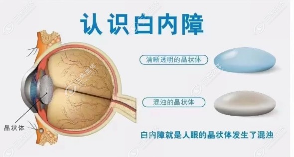 白内障手术报销后一般自费需要4000-万元不等