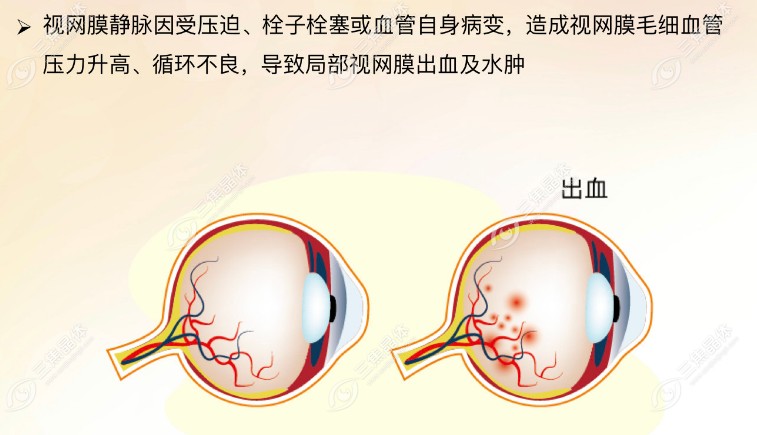 眼底中央静脉阻塞能治好吗?挺难