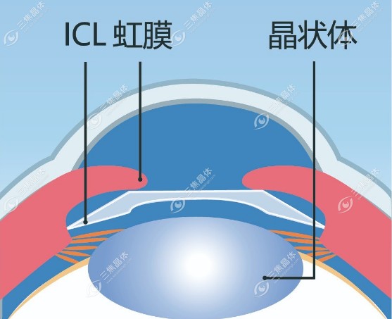 术后中晚期恢复阶段