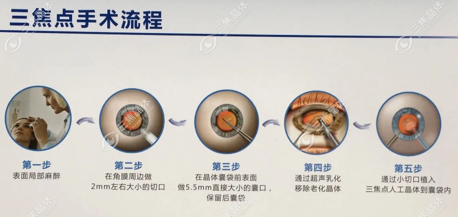 三焦晶体置换手术后遗症有哪些? 可能出现的后遗症有：暂时性视力模糊、干眼、视力波动、感染、后发性白内障等。