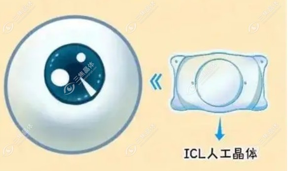 深圳做icl晶体植入手术好的医院和医生在这,高度近视必看
