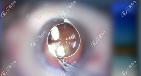 三焦晶体置换手术后遗症有哪些?暂时性视力模糊/干眼等症状