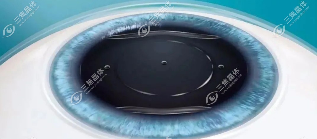 广州做icl晶体植入手术好的医院和医生名单公布,含公办/私立