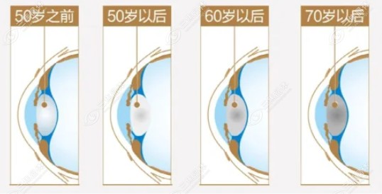 白内障3000/4000元的晶体好@www.sanjiaojingti.com/