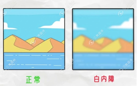 白内障万元人工晶体好