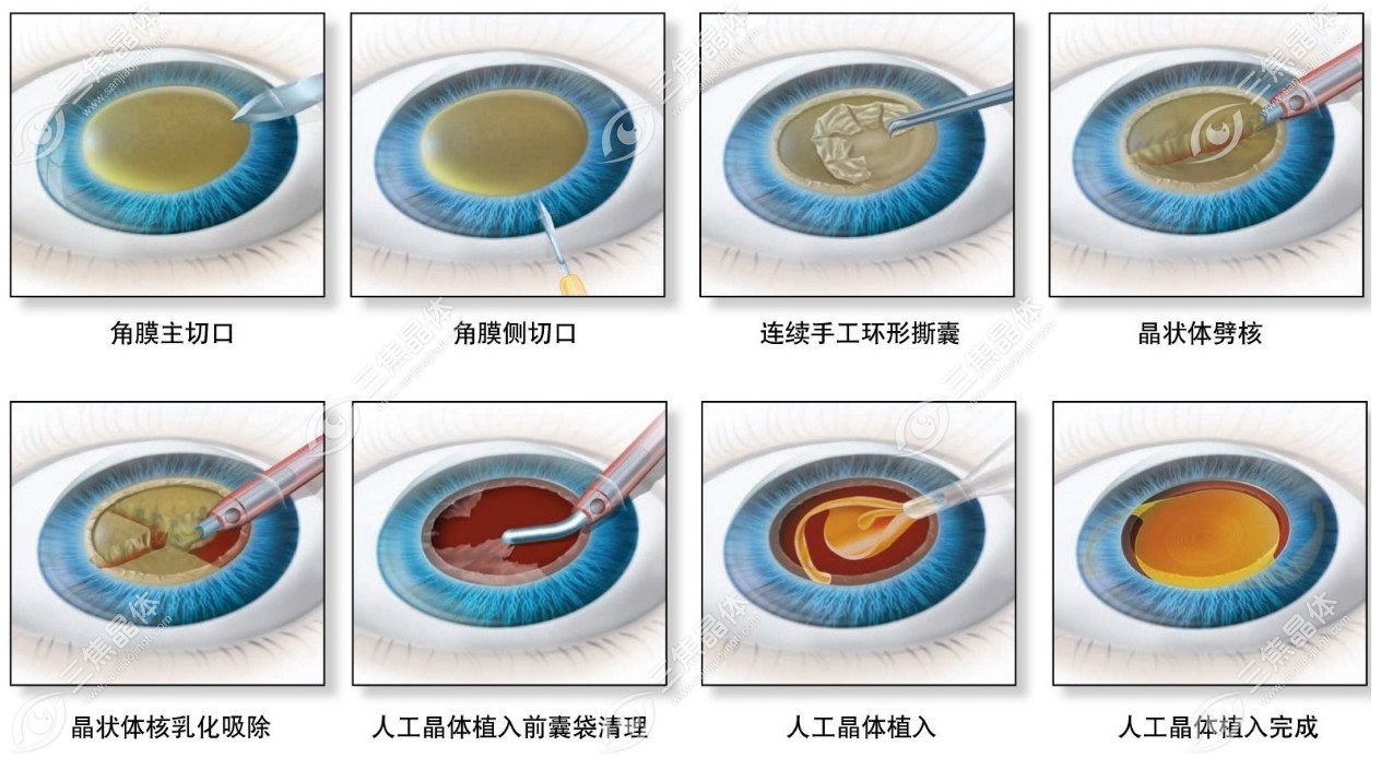 人工晶体可以取出二次植入吗?可以