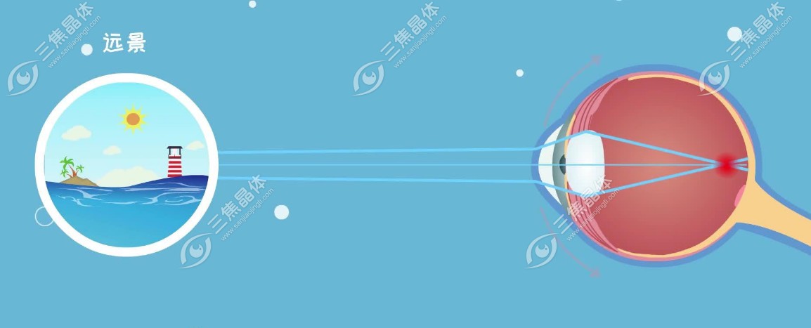 近处清晰，远处模糊（看远不清）