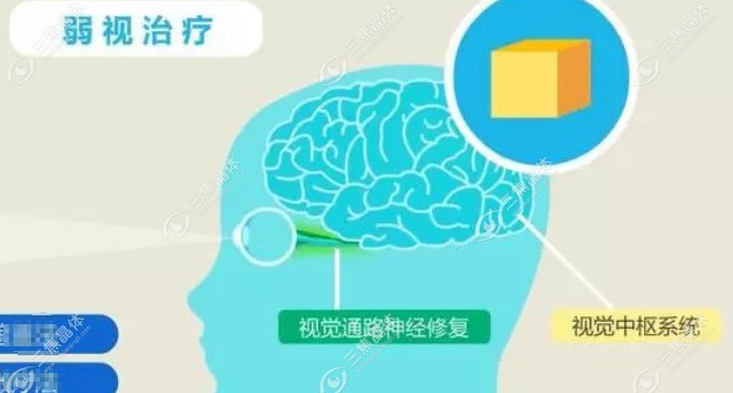 成人弱视眼睛除了做矫正手术还能通过这些方法改善