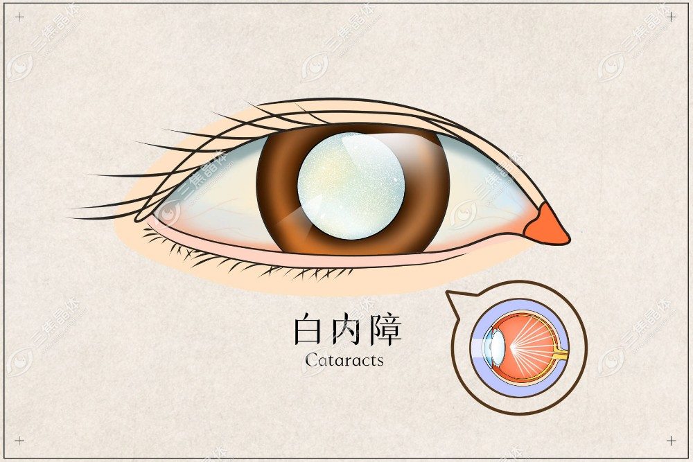 白内障晶体摘除后不植入人工晶体可以吗www.sanjiaojingti.com