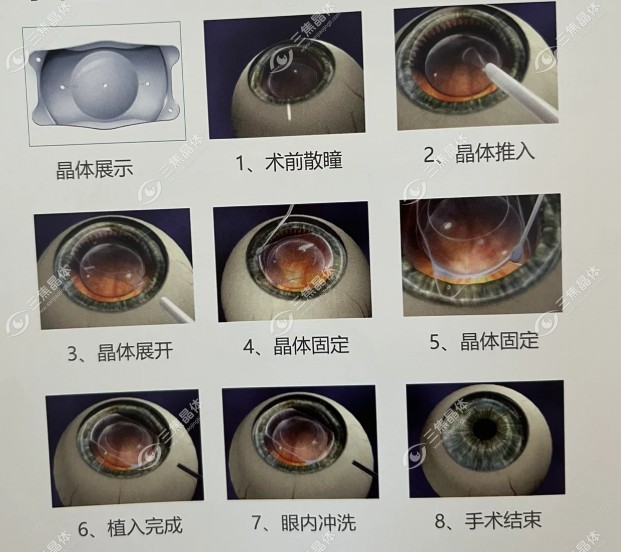 眼睛植入晶体植入手术过程图片