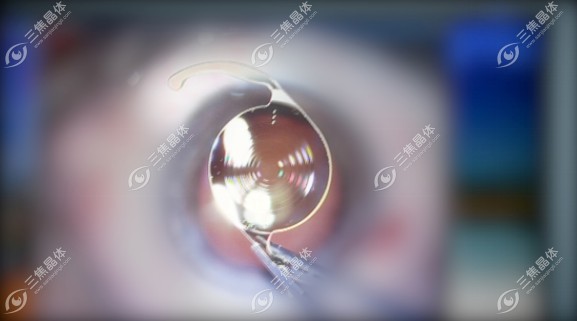 三焦点人工晶体手术一般没有后发障
