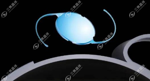 sn60wf人工晶状体参数：紫外线和蓝光滤过型丙烯酸酯可折叠单片式后房型人工晶体