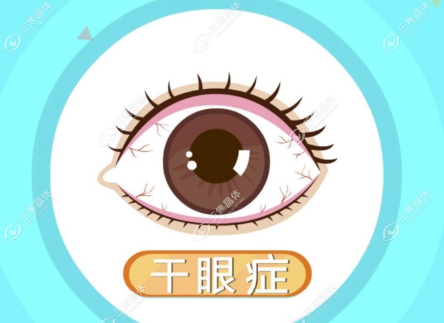 角膜荧光染色阳性还可能表示患有眼干症