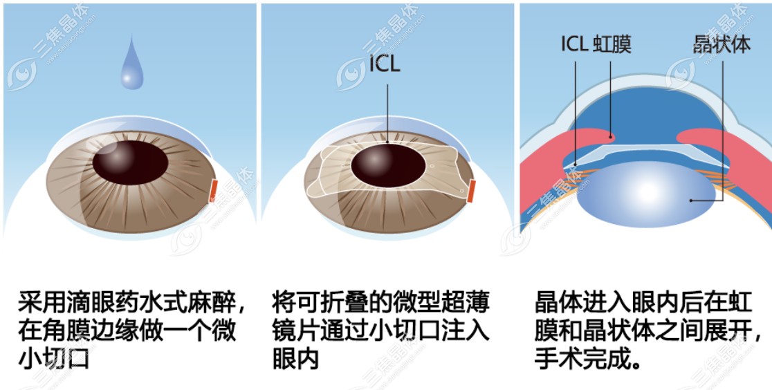 为什么眼角膜太薄做不了激光类近视手术推荐晶体植入手术