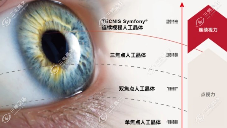 强生视力康人工晶体有4种型号：pcb00、ZMB00、GCB00、ZXR00