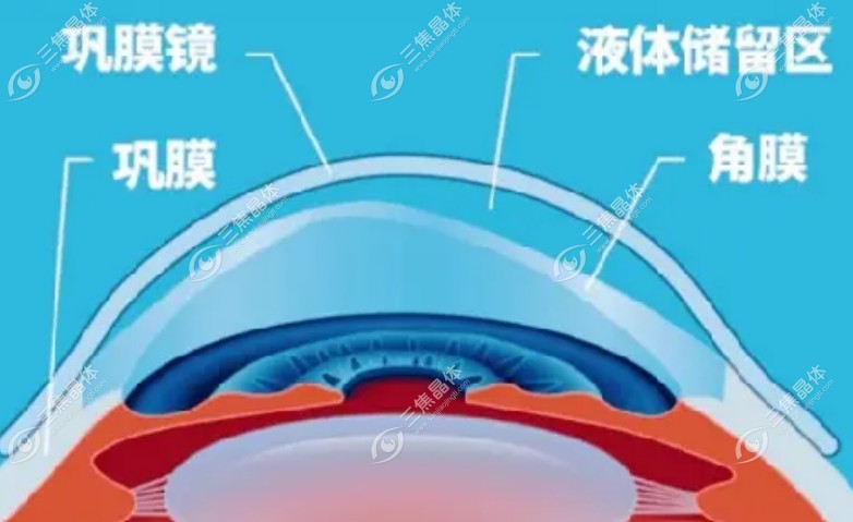 福州东南眼科医院的巩膜镜技术应用
