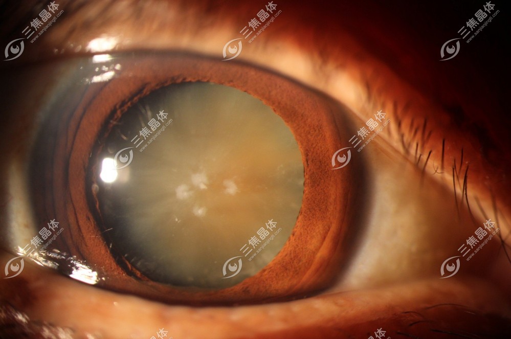 非球面人工晶体是一种特殊的晶体设计~三焦晶体