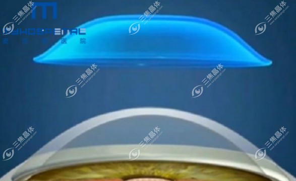 麦迪格和爱尔眼科哪家角膜塑形镜好?各有各的好